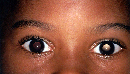 Close-up of child’s eyes showing anisometropia, or lazy eye