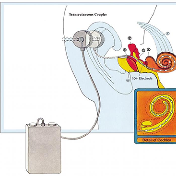 The cochlear implant produces electrical impulses in the ear