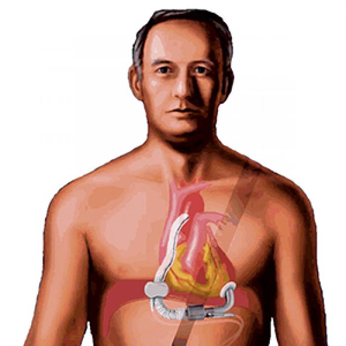 MicroMed DeBakey VAD as a bridge to heart transplant