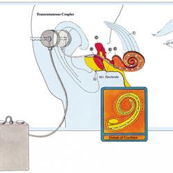 The cochlear implant produces electrical impulses in the ear